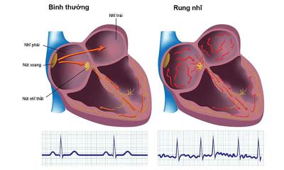 Tâm Nhĩ Là Gì? Các Bệnh Thường Gặp Ở Tâm Nhĩ