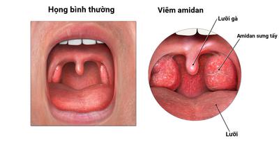 Những Lưu Ý Sau Khi Cắt Amidan Để Cơ Thể Nhanh Hồi Phục