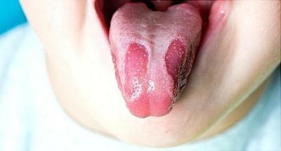 Rát Lưỡi Là Bệnh Gì? Những Nguyên Nhân Gây Ra Tình Trạng Rát Lưỡi, Khô Miệng Kéo Dài